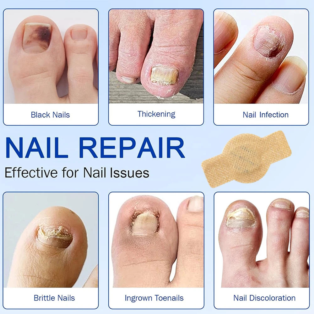 Nail Secure Repair Patch